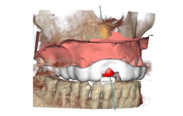 3D-geplante Bohrschablone für die Implantation