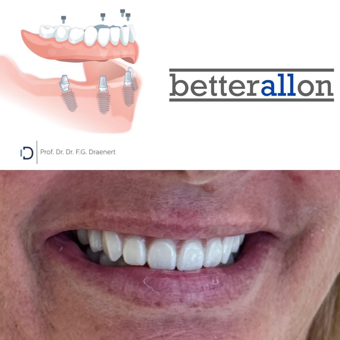 betterallon®: Illustration der Brücke auf Implantaten und Ergebnis bei einer Patientin