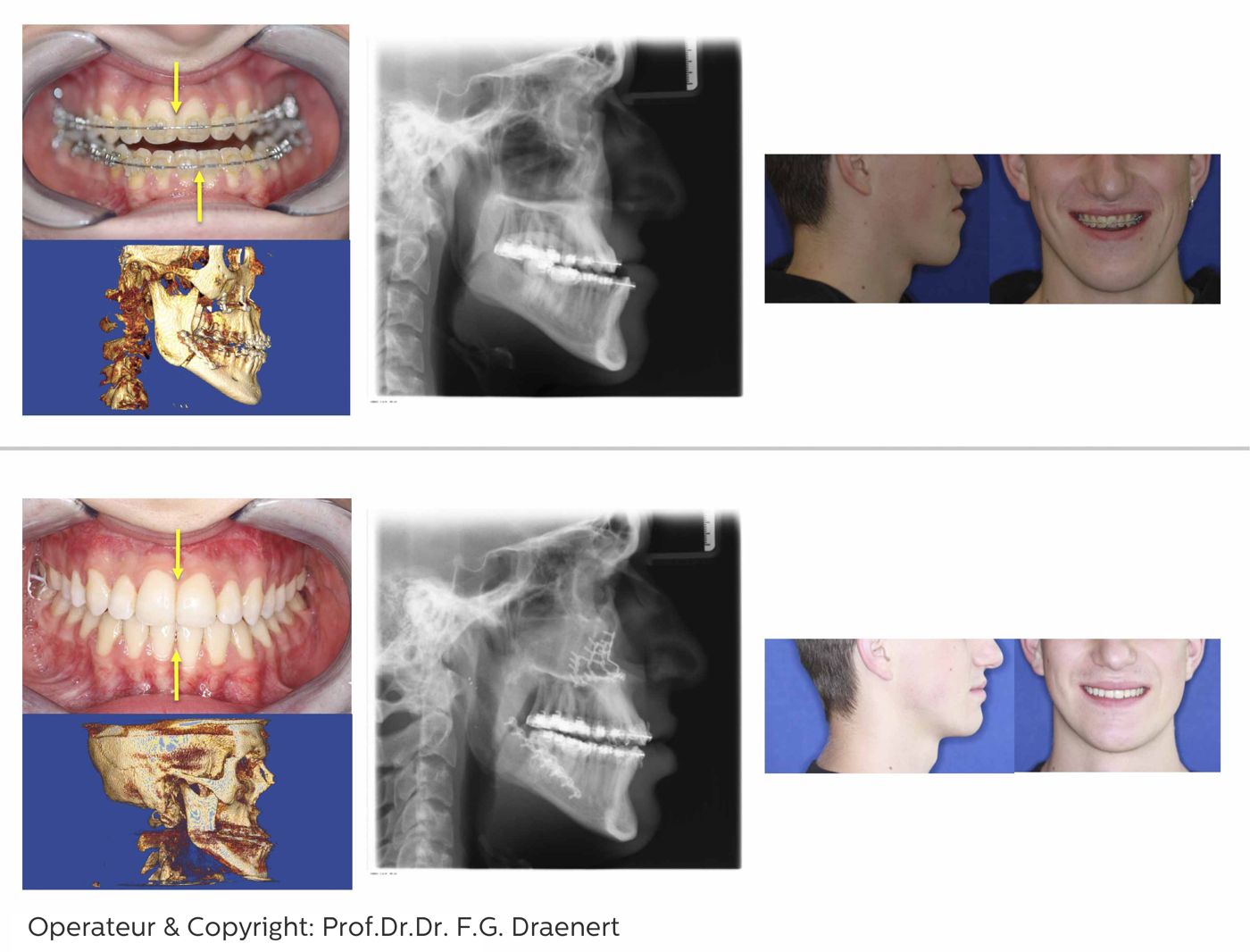 Fallbeispiel Dysgnathiechirurgie mit 3D-Planung