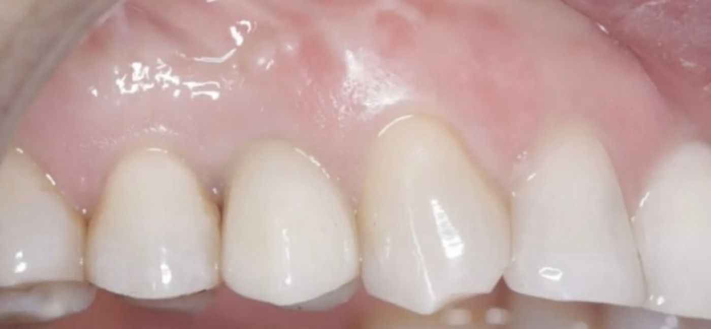 Implantatkrone im Oberkiefer, kaum von natürlichen Zähnen zu unterscheiden