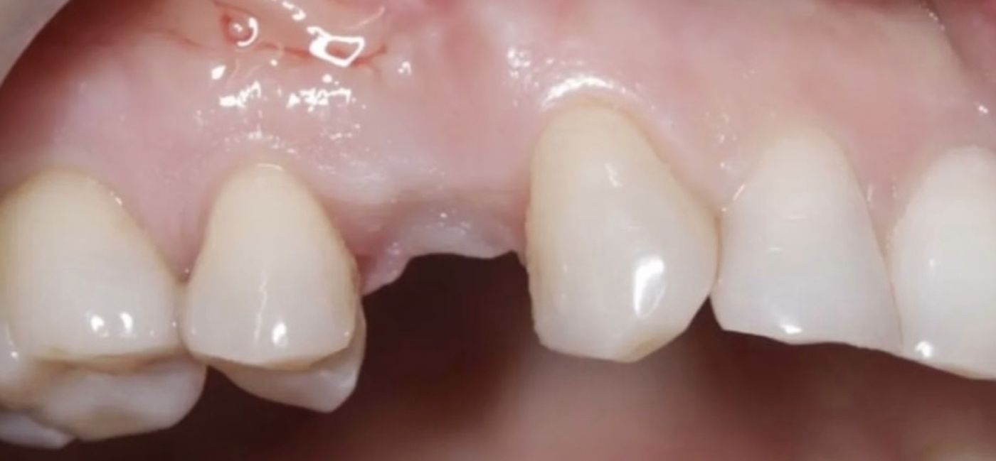 Zahnlücke im Oberkiefer vor der Implantatbehandlung