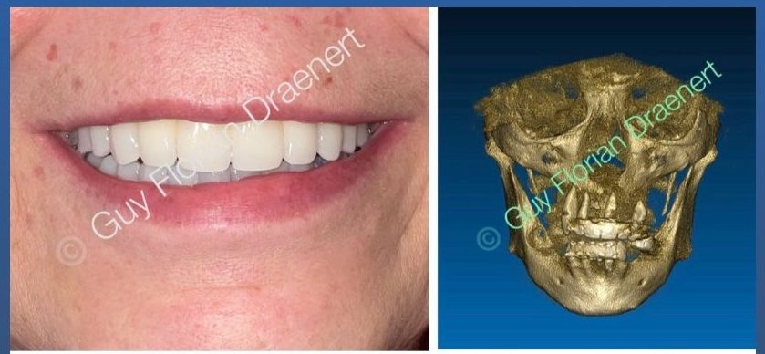 Patientin mit festen Zähnen nach Full-Arch-Versorgung und 3D-Röntgen vor der Behandlung