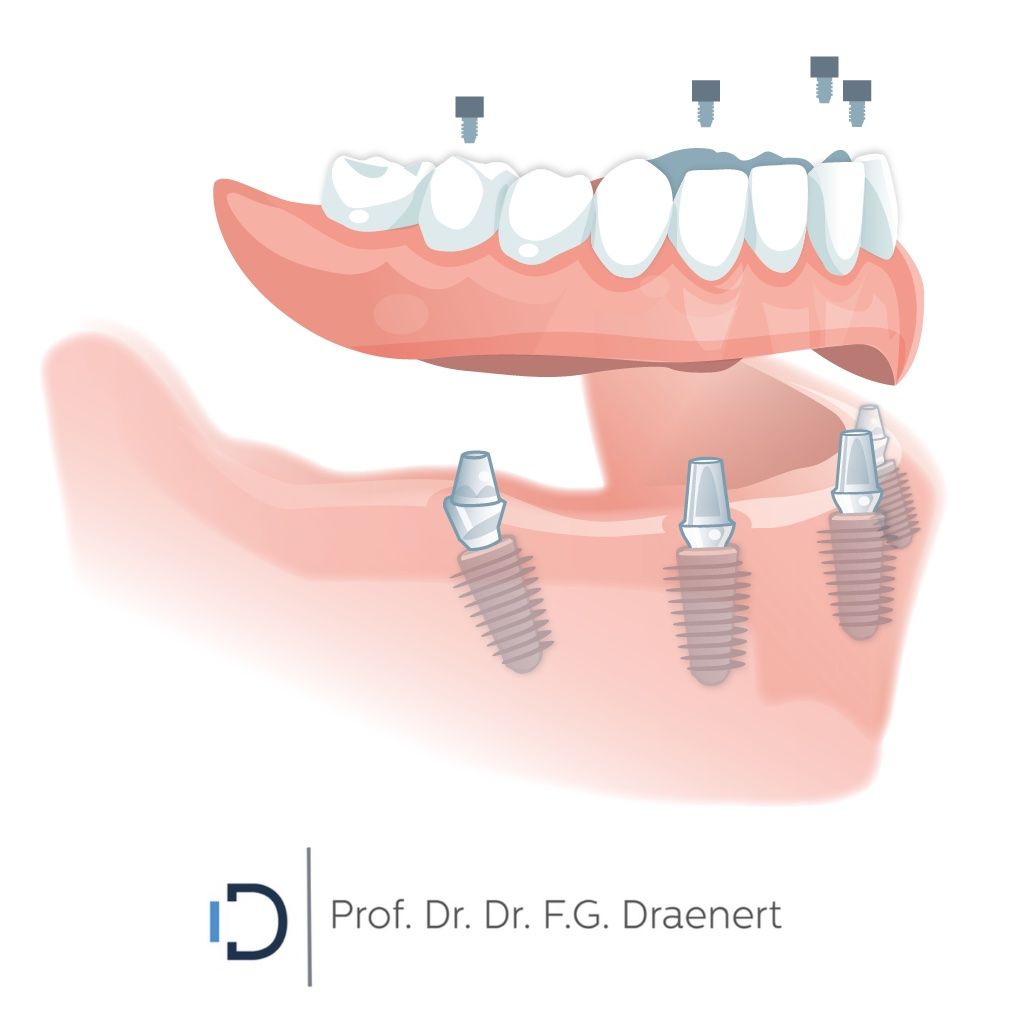 Illustration: Brücke auf vier Implantaten