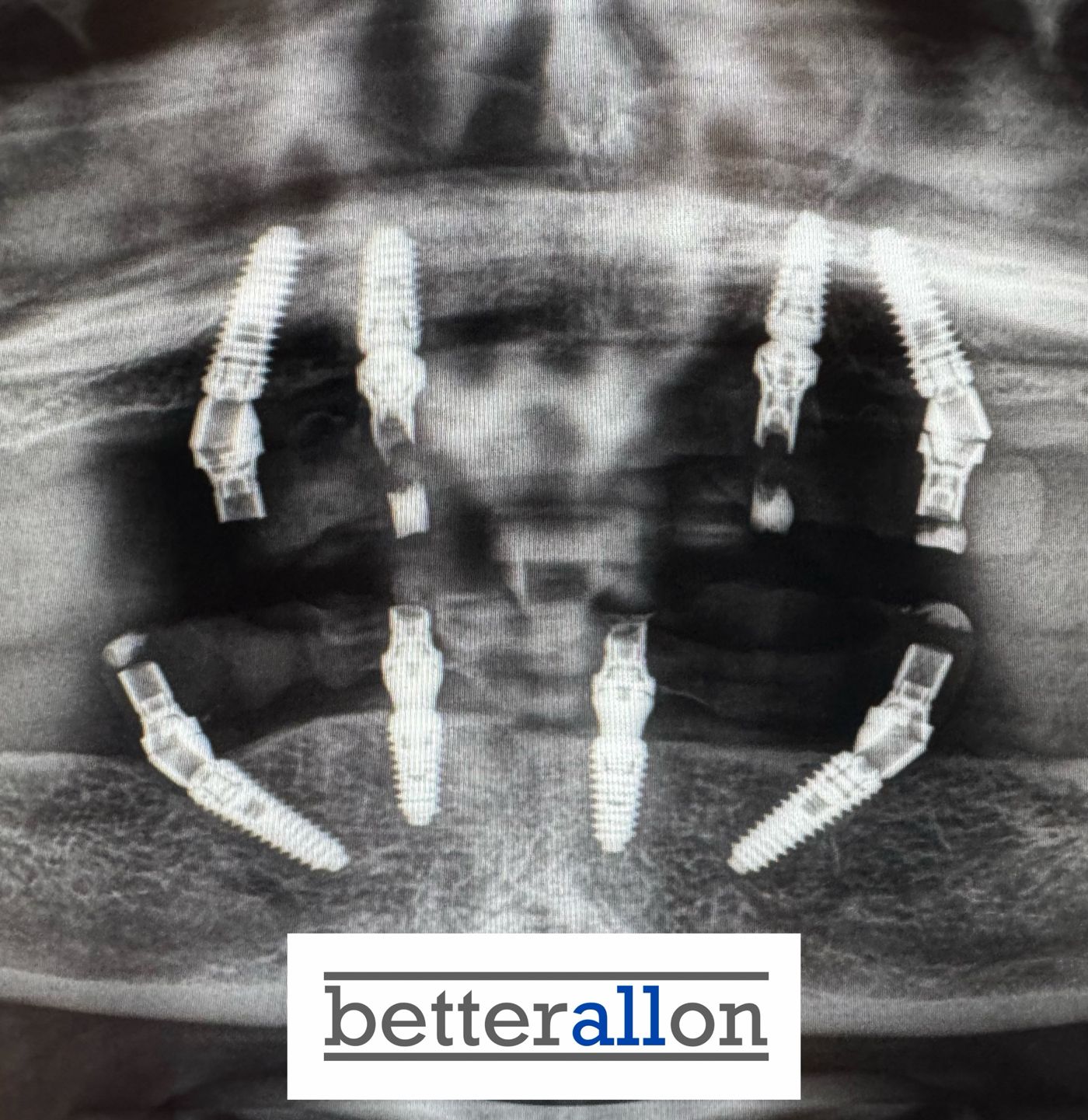 Röntgenbild: Full-Arch-Versorgung in Ober- und Unterkiefer mit schräg gesetzten Implantaten