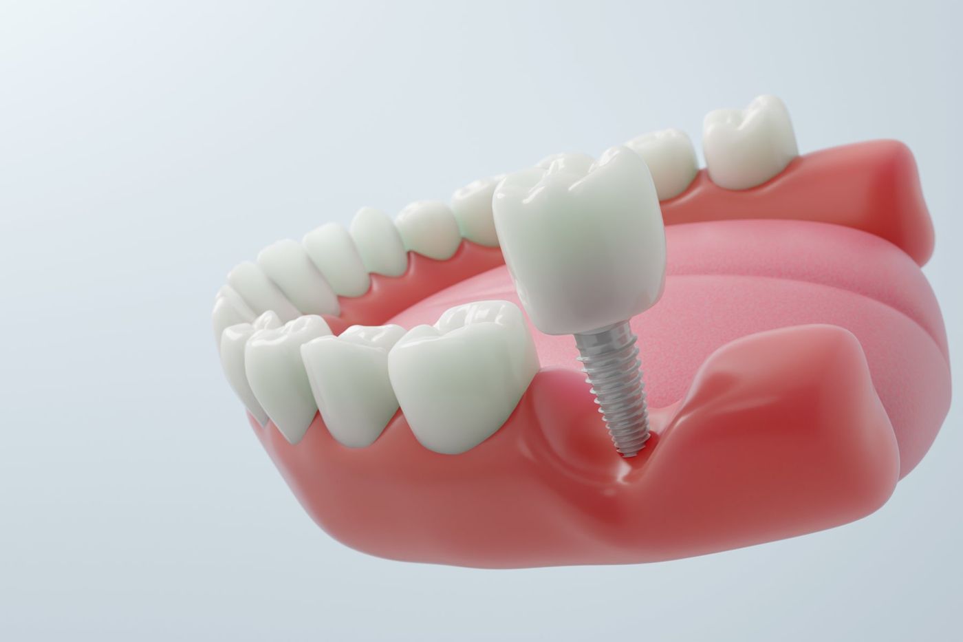 Illustration eines Implantats mit Krone