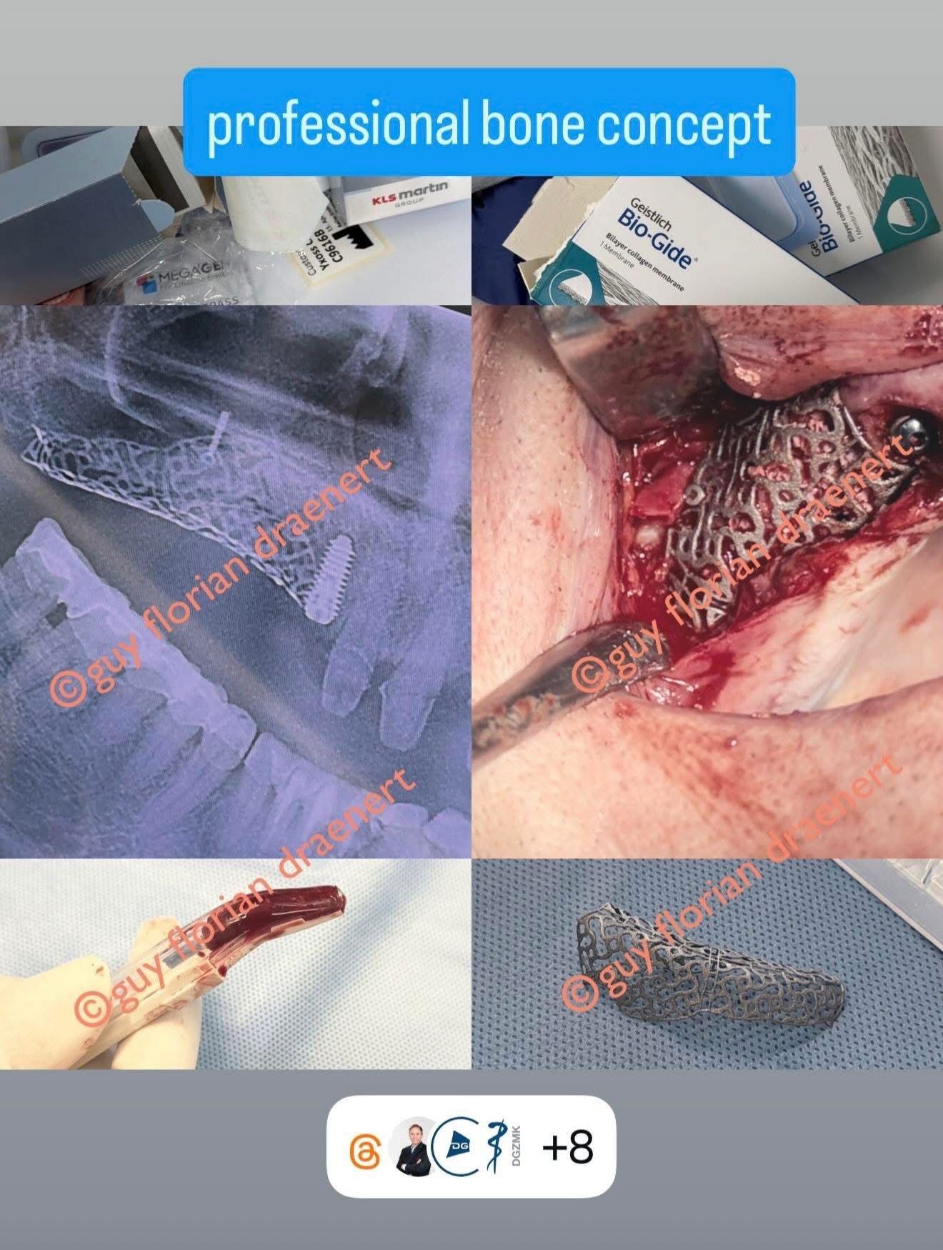 Professional bone concept: Material, Röntgen, Operation und Titangitter
