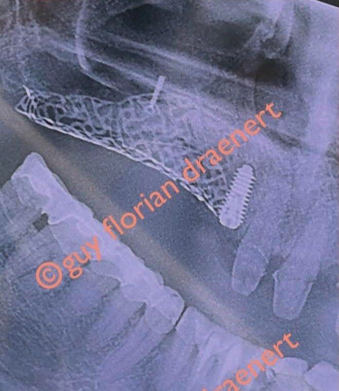 Röntgenbild: individuell gefertigtes Titangitter über dem Knochenaufbau mit Implantat