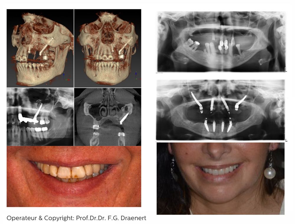 Fallbeispiel Zygoma-Implantate